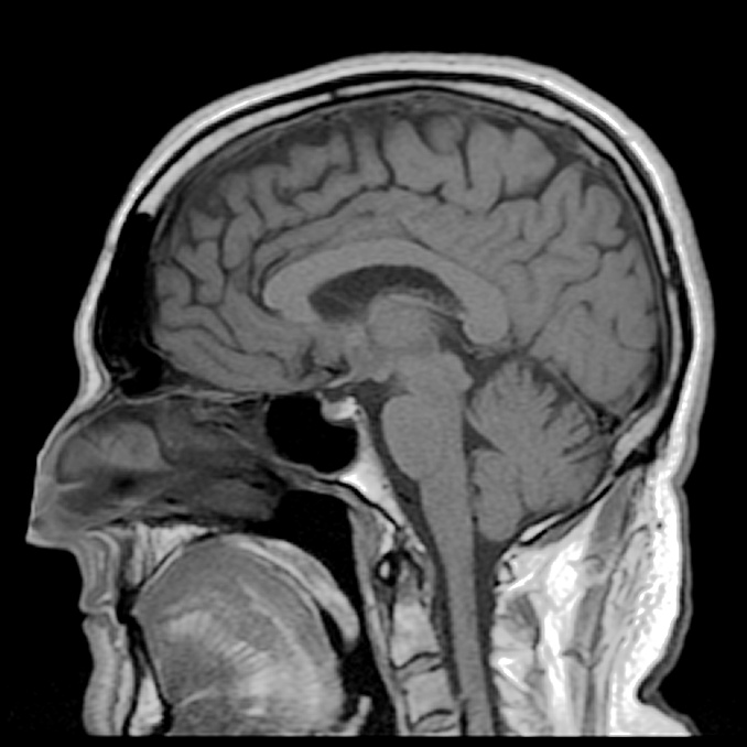 agittal T1 Midline MRI Scan of Reigh's Brain | by Reigh LeBlanc